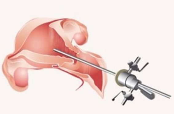 Endometrial Scratching