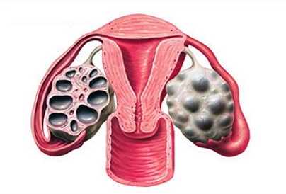 Ovarian Hyperstimulation Syndrome